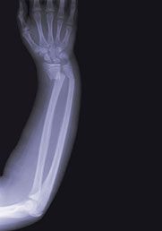 This is a photo of an x-ray of someone's arm.